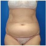 Liposuction Before & After Patient #429