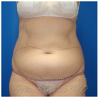 Liposuction Before & After Patient #429