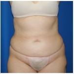 Liposuction Before & After Patient #429