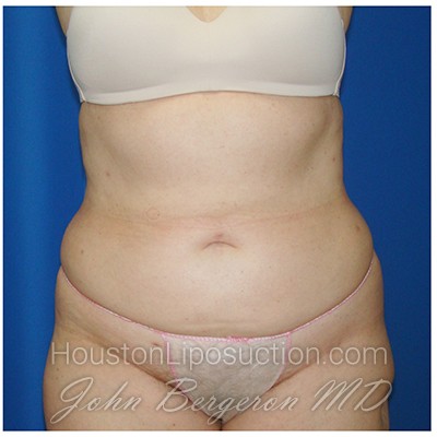 Liposuction Before & After Patient #429