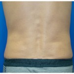 Liposuction Before & After Patient #281