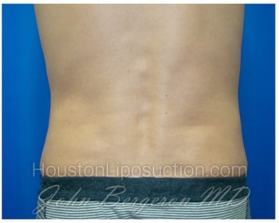 Liposuction Before & After Patient #281