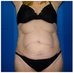 Liposuction Before & After Patient #284