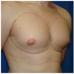 Liposuction Before & After Patient #432