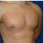 Liposuction Before & After Patient #432