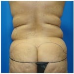 Liposuction Before & After Patient #435