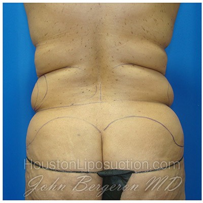 Liposuction Before & After Patient #435