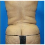 Liposuction Before & After Patient #435