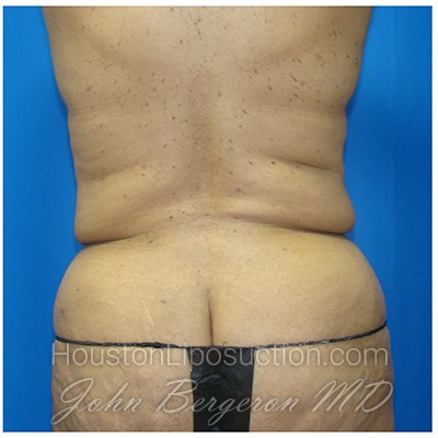Liposuction Before & After Patient #435