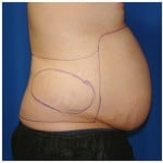 Liposuction Before & After Patient #438