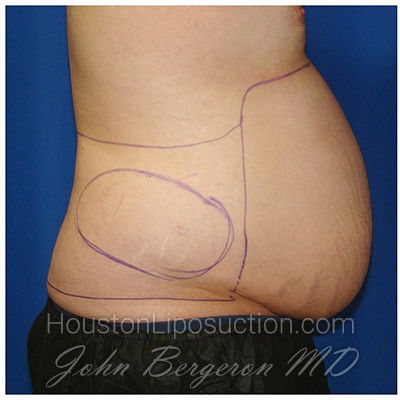 Liposuction Before & After Patient #438