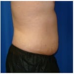 Liposuction Before & After Patient #438