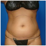 Liposuction Before & After Patient #441