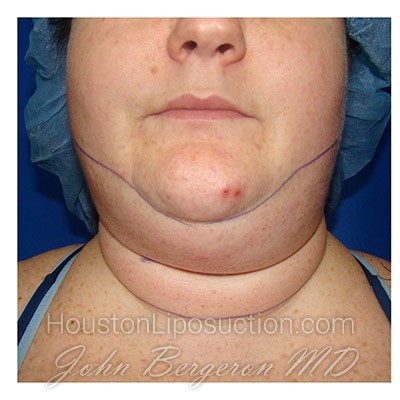 Liposuction Before & After Patient #287