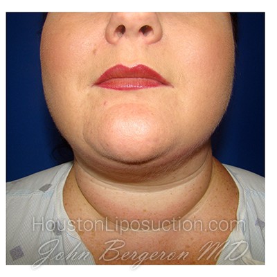 Liposuction Before & After Patient #287