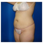 Liposuction Before & After Patient #290