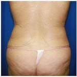 Liposuction Before & After Patient #293