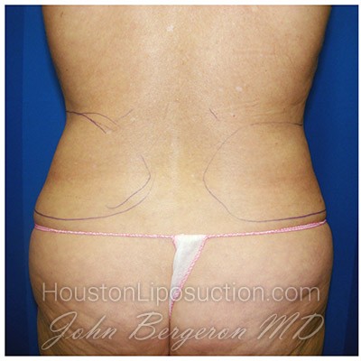 Liposuction Before & After Patient #293