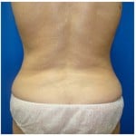 Liposuction Before & After Patient #293