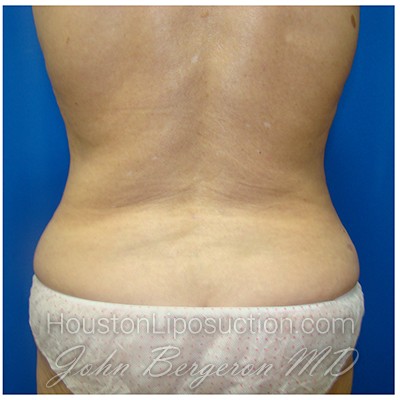 Liposuction Before & After Patient #293