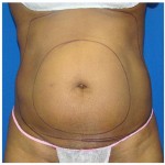 Liposuction Before & After Patient #763