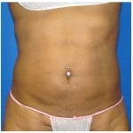 Liposuction Before & After Patient #763