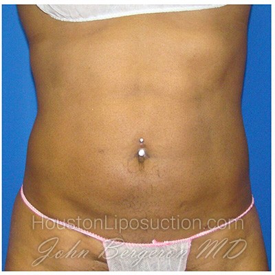 Liposuction Before & After Patient #763