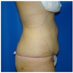 Liposuction Before & After Patient #766
