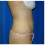 Liposuction Before & After Patient #766