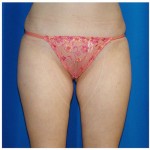 Liposuction Before & After Patient #769