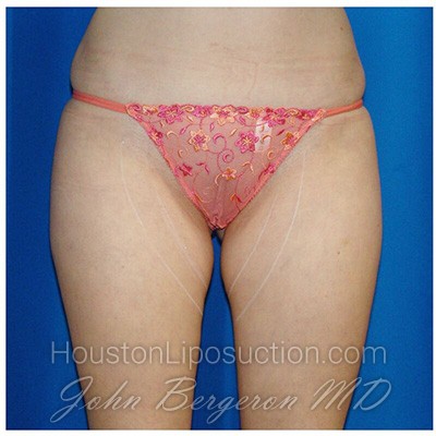 Liposuction Before & After Patient #769