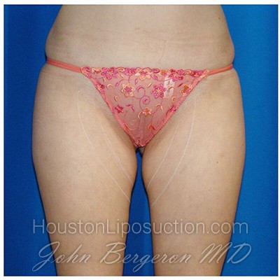 Liposuction Before & After Patient #769