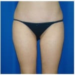 Liposuction Before & After Patient #769