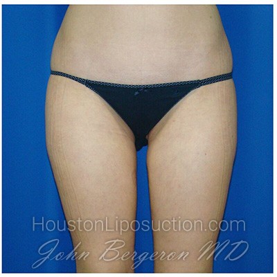 Liposuction Before & After Patient #769