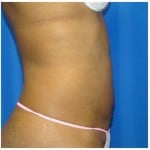 Liposuction Before & After Patient #763