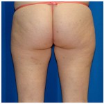 Liposuction Before & After Patient #769