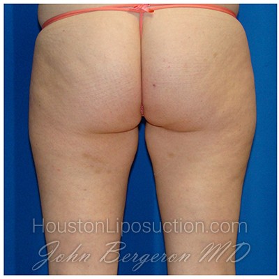 Liposuction Before & After Patient #769