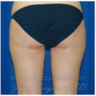 Liposuction Before & After Patient #769