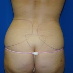 Liposuction Before & After Patient #766