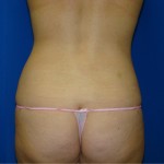 Liposuction Before & After Patient #766