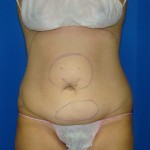 Liposuction Before & After Patient #766