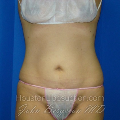 Liposuction Before & After Patient #766