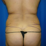 Liposuction Before & After Patient #843