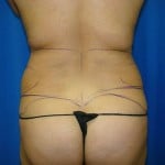 Liposuction Before & After Patient #843