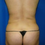 Liposuction Before & After Patient #843