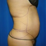 Liposuction Before & After Patient #843