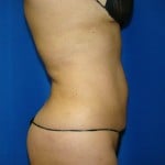 Liposuction Before & After Patient #843