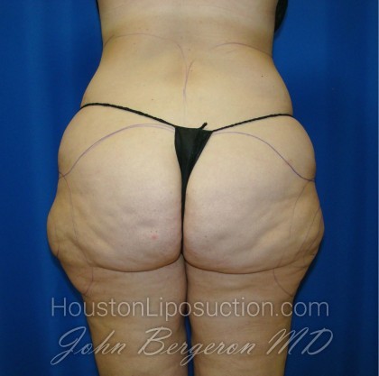 Liposuction Before & After Patient #861