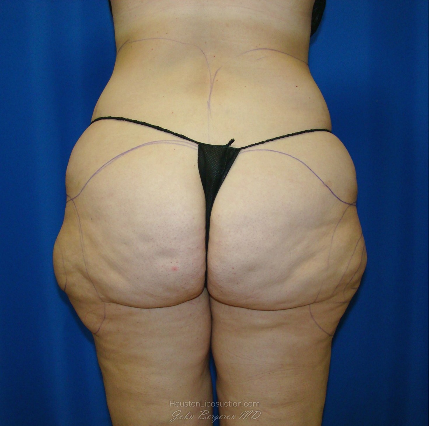 Liposuction Before & After Patient #861