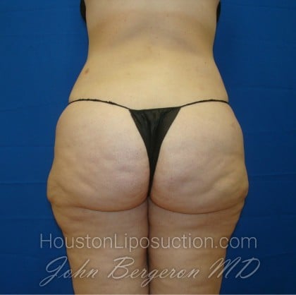 Liposuction Before & After Patient #861